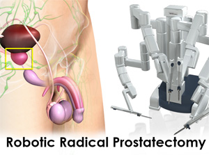 pensión entrega Dependiente Robotic Radical Prostatectomy Bundaberg | Prostate Cancer Brisbane QLD
