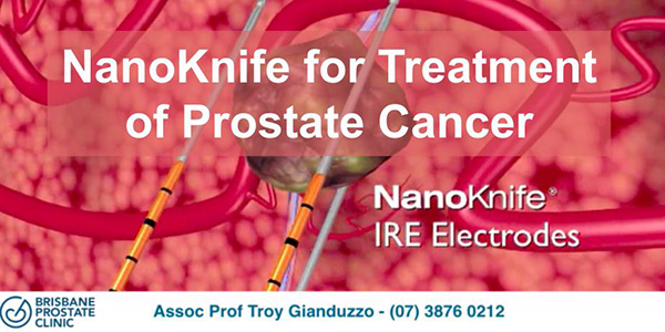 NANOKNIFE TREATMENT FOR PROSTATE CANCER