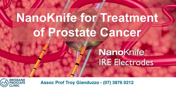 NANOKNIFE TREATMENT FOR PROSTATE CANCER