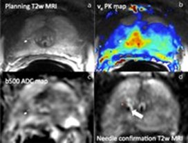 Prostate MRI