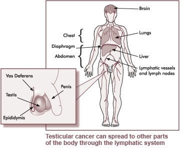 Testicular cancer